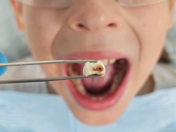 Best Emergency Root Canal Treatment in Marion, KY